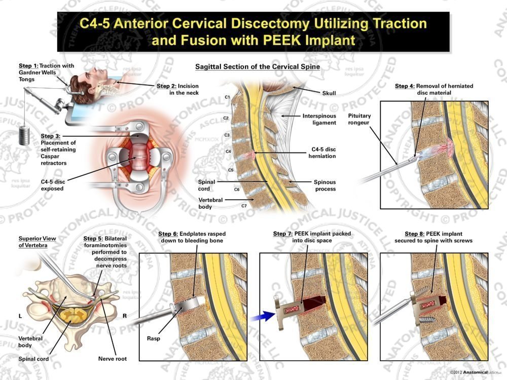Male C3-4 Anterior Cervical Discectomy Utilizing Traction and Fusion with PEEK Implant