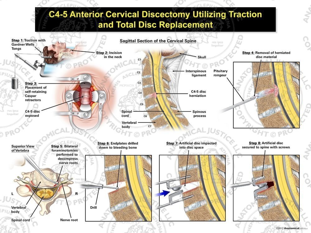 Male C4-5 Anterior Cervical Discectomy Utilizing Traction and Total Disc Replacement
