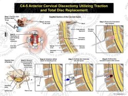 Female C4-5 Anterior Cervical Discectomy Utilizing Traction and Total Disc Replacement