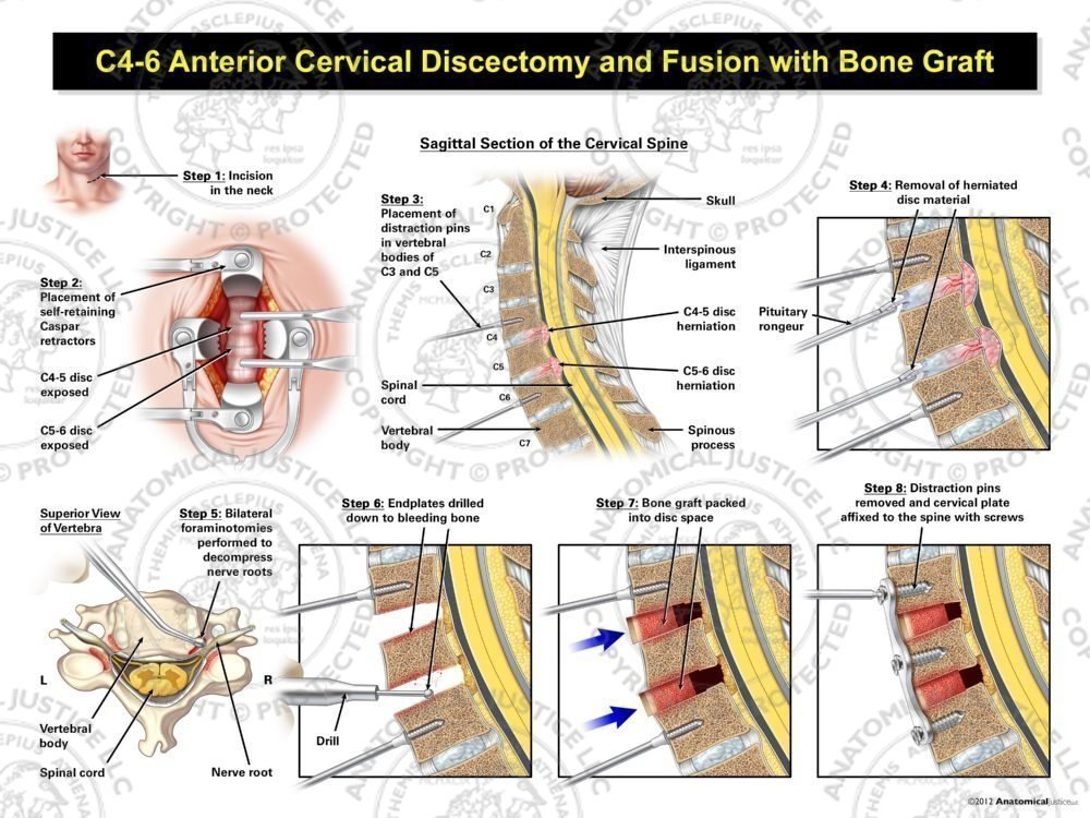 C4-6 Anterior Cervical Discectomy and Fusion with Bone Graft