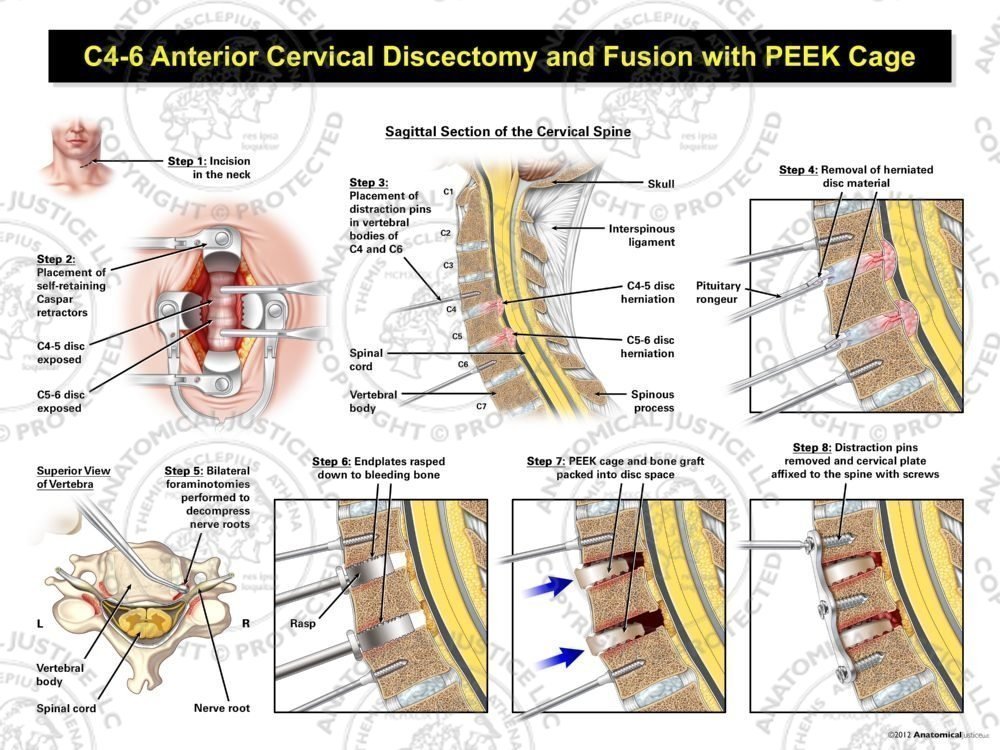 C4-6 Anterior Cervical Discectomy and Fusion with PEEK Cage