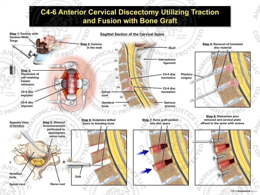 Male C4-6 Anterior Cervical Discectomy Utilizing Traction and Fusion with Bone Graft
