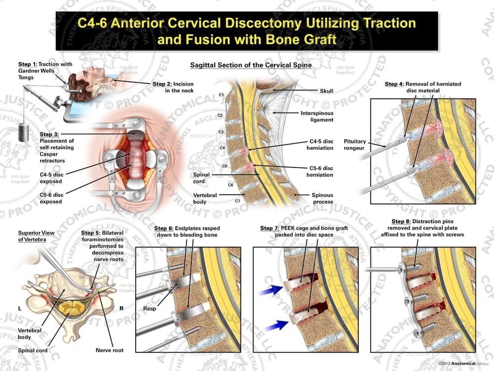 Male C4-6 Anterior Cervical Discectomy Utilizing Traction and Fusion with PEEK Cage