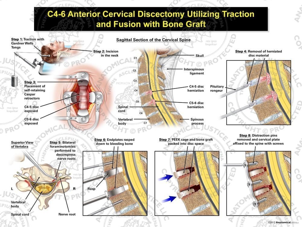 Female C4-6 Anterior Cervical Discectomy Utilizing Traction and Fusion with PEEK Cage