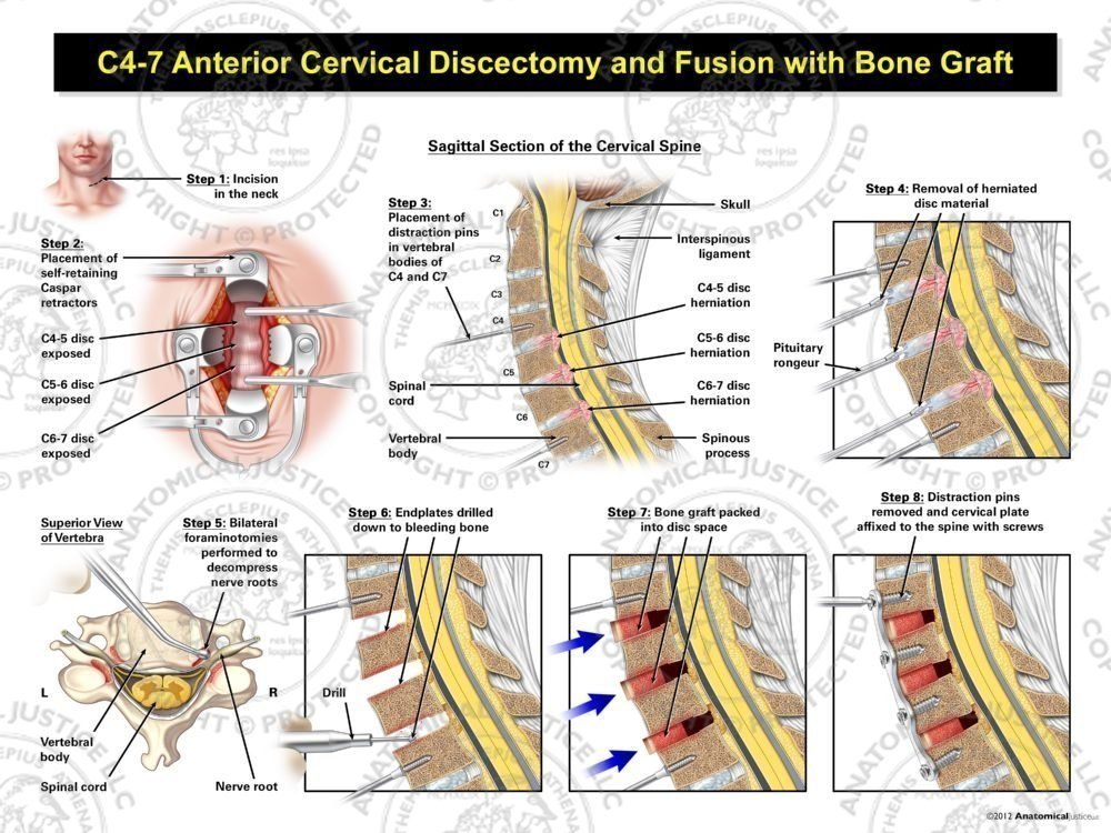 C4-7 Anterior Cervical Discectomy and Fusion with Bone Graft