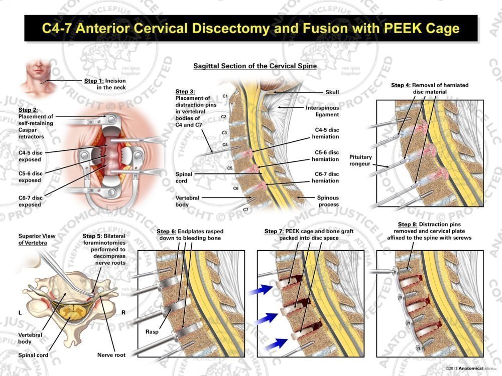 C4-7 Anterior Cervical Discectomy and Fusion with PEEK Cage