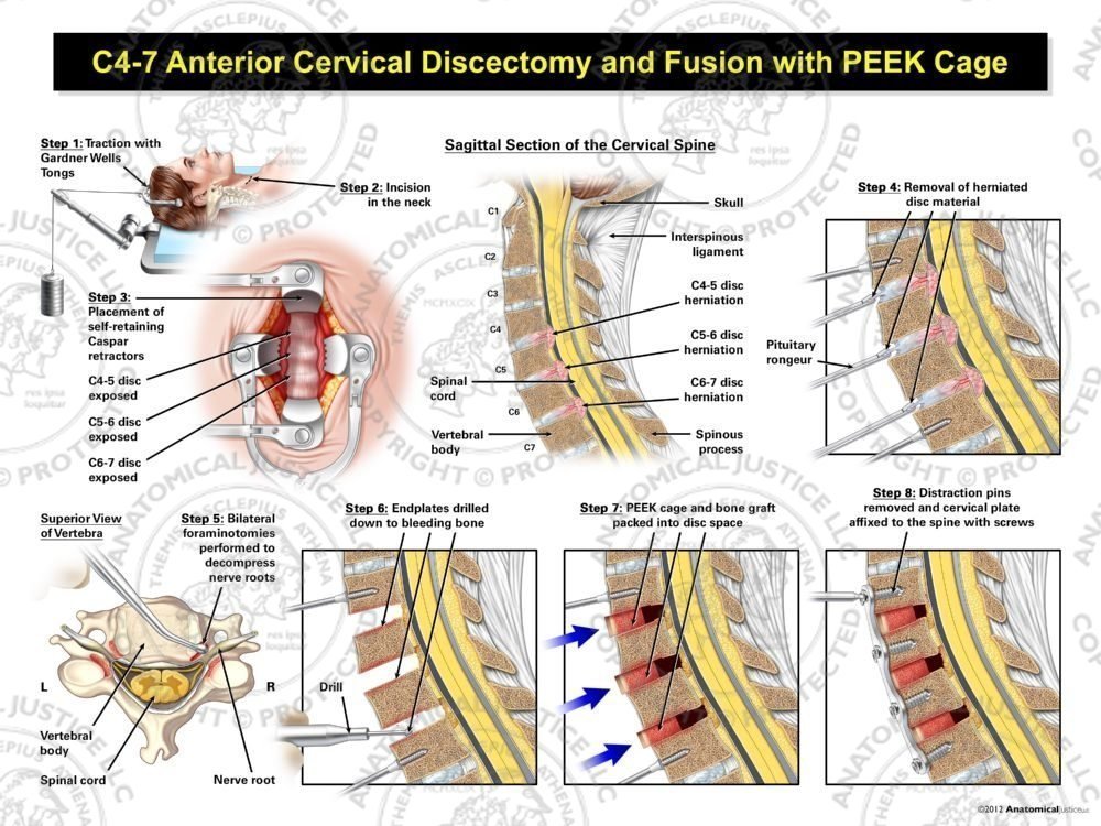 Female C4-7 Anterior Cervical Discectomy Utilizing Traction and Fusion with Bone Graft