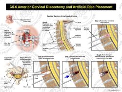 C5-6 Anterior Cervical Discectomy and Artificial Disc Placement
