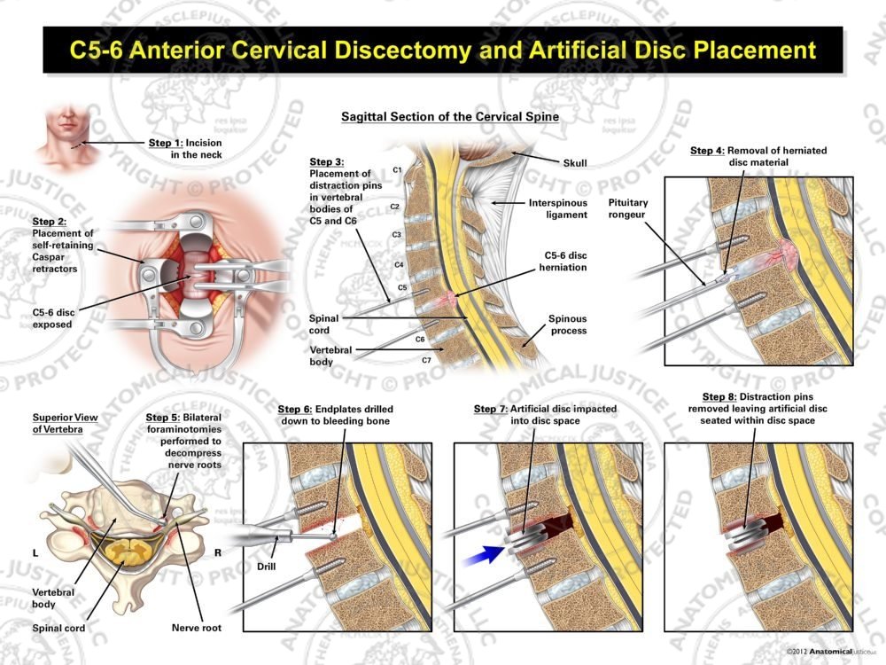 C5-6 Anterior Cervical Discectomy and Artificial Disc Placement