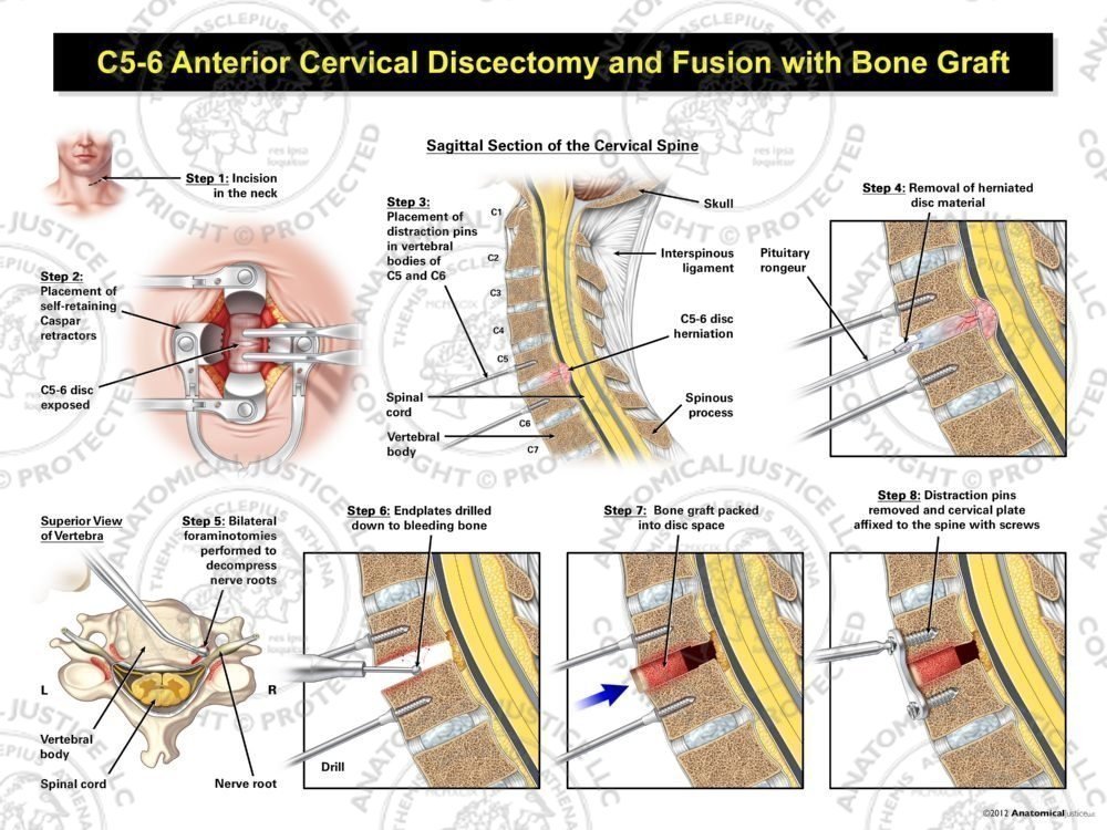 C5-6 Anterior Cervical Discectomy and Fusion with Bone Graft