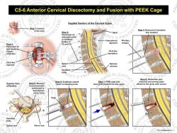 C5-6 Anterior Cervical Discectomy and Fusion with PEEK Cage