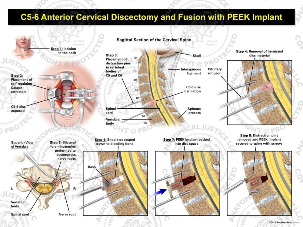 C5-6 Anterior Cervical Discectomy and Fusion with PEEK Implant