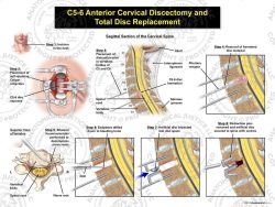 C5-6 Anterior Cervical Discectomy and Total Disc Replacement