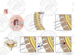 C5-6 Anterior Cervical Discectomy and Total Disc Replacement – No Text