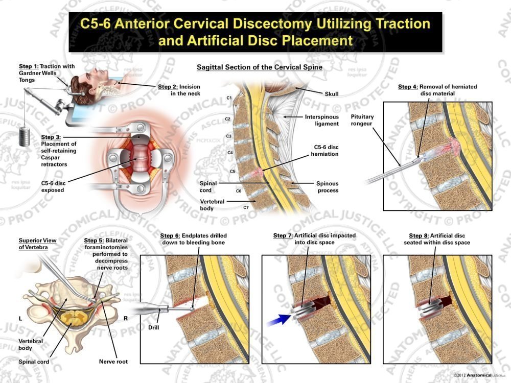 Male C5-6 Anterior Cervical Discectomy Utilizing Traction and Artificial Disc Placement