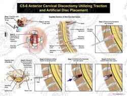 Female C5-6 Anterior Cervical Discectomy Utilizing Traction and Artificial Disc Placement