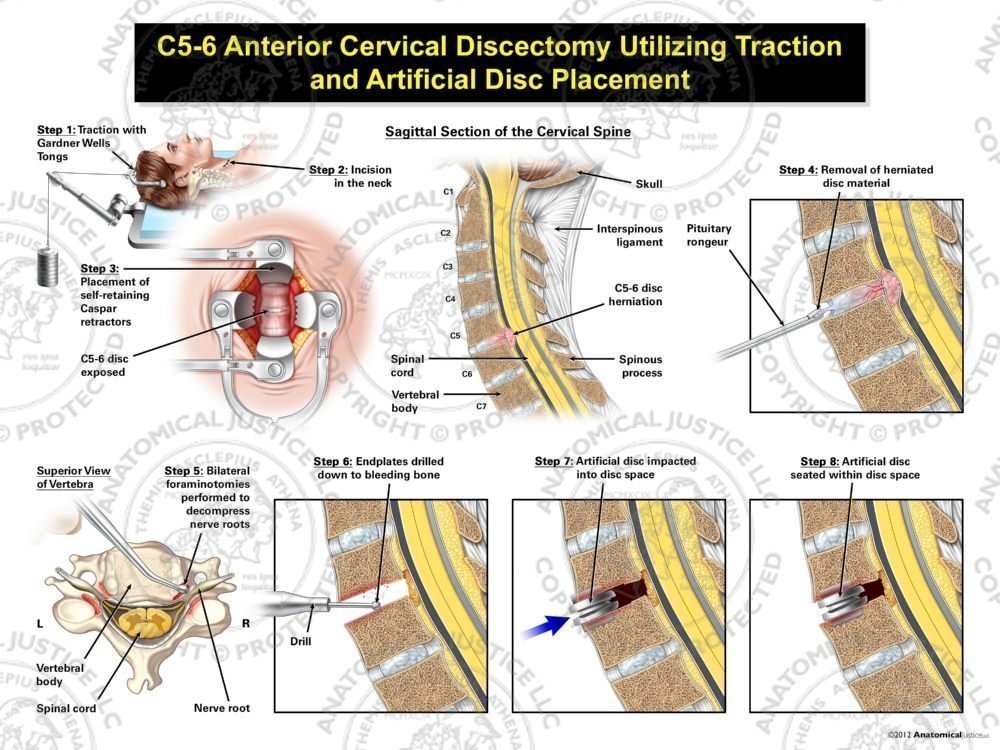 Female C5-6 Anterior Cervical Discectomy Utilizing Traction and Artificial Disc Placement
