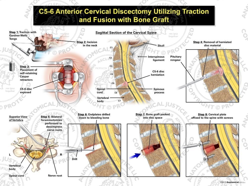 Male C5-6 Anterior Cervical Discectomy Utilizing Traction and Fusion with Bone Graft