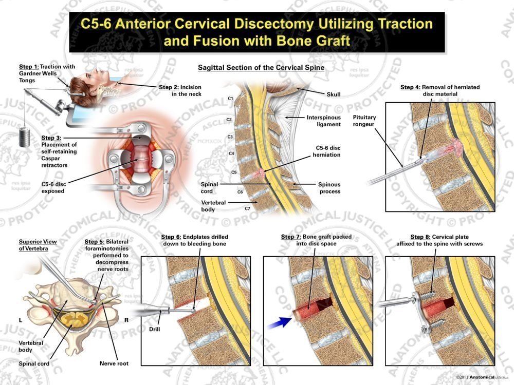 Female C5-6 Anterior Cervical Discectomy Utilizing Traction and Fusion with Bone Graft