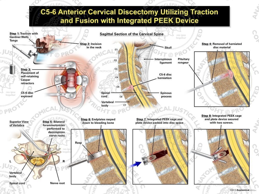 Male C5-6 Anterior Cervical Discectomy Utilizing Traction and Fusion with Integrated PEEK Device