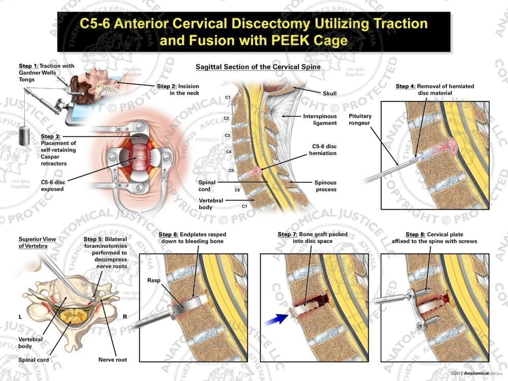 Male C5-6 Anterior Cervical Discectomy Utilizing Traction and Fusion with PEEK Cage