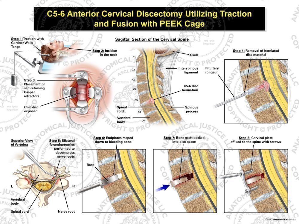 Female C5-6 Anterior Cervical Discectomy Utilizing Traction and Fusion with PEEK Cage
