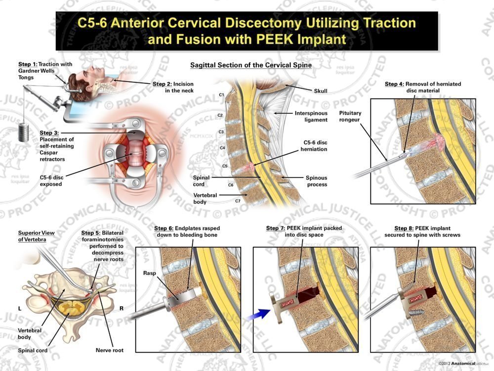 Male C5-6 Anterior Cervical Discectomy Utilizing Traction and Fusion with PEEK Implant