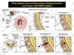 Female C5-6 Anterior Cervical Discectomy Utilizing Traction and Fusion with PEEK Implant