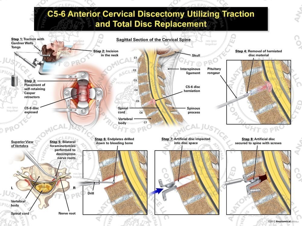 Male C5-6 Anterior Cervical Discectomy Utilizing Traction and Total Disc Replacement