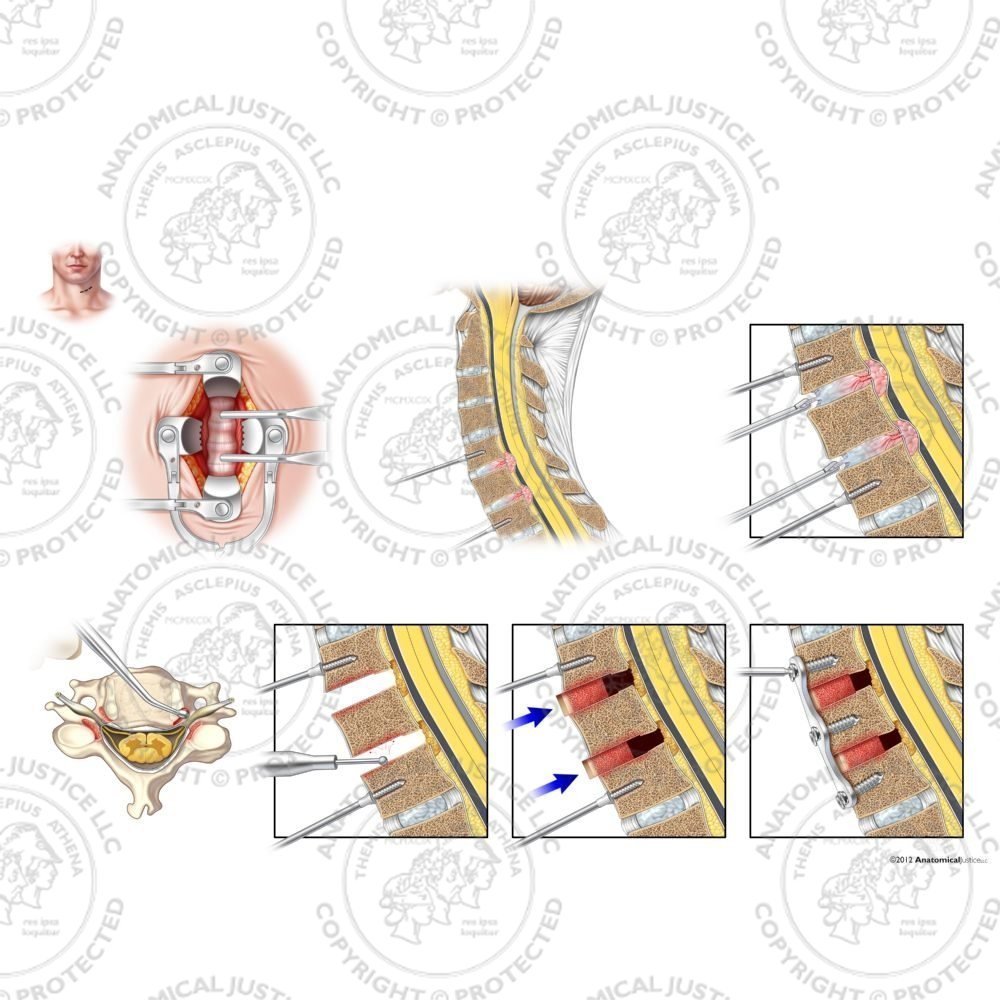 C5-7 Anterior Cervical Discectomy and Fusion with Bone Graft – No Text
