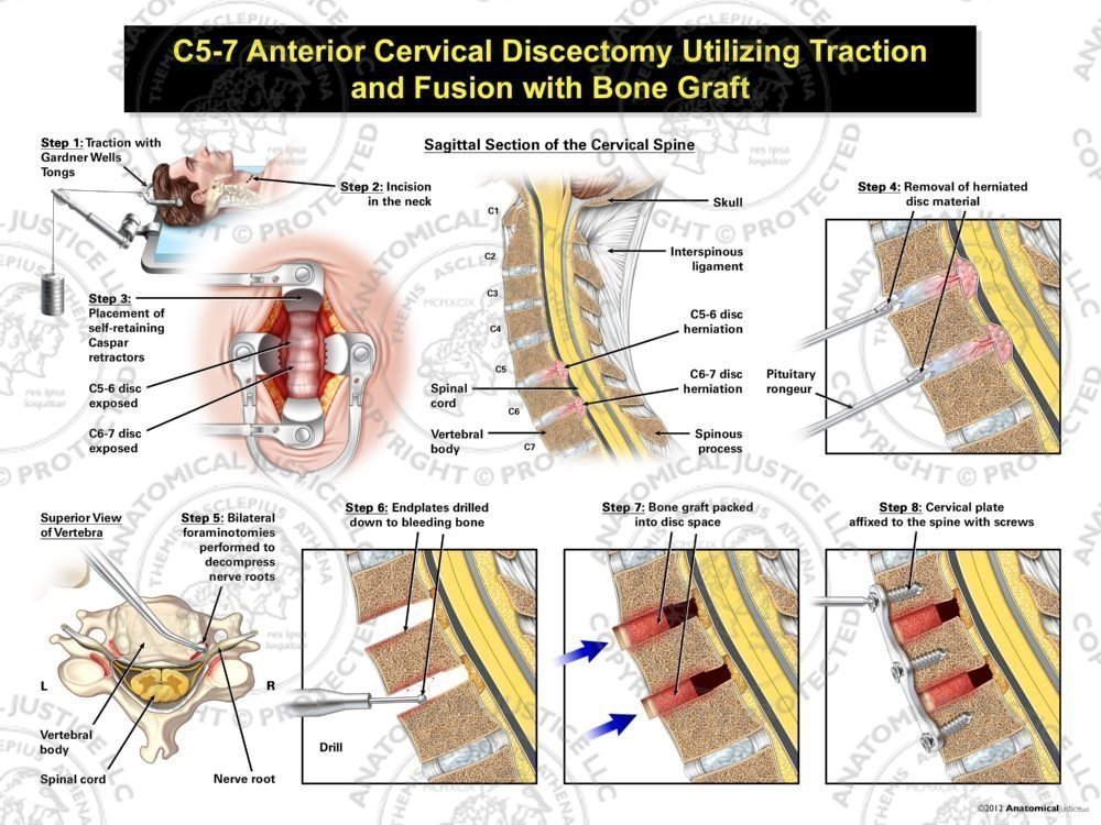 Male C5-7 Anterior Cervical Discectomy Utilizing Traction and Fusion with Bone Graft