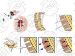 Male C5-7 Anterior Cervical Discectomy Utilizing Traction and Fusion with Bone Graft – No Text