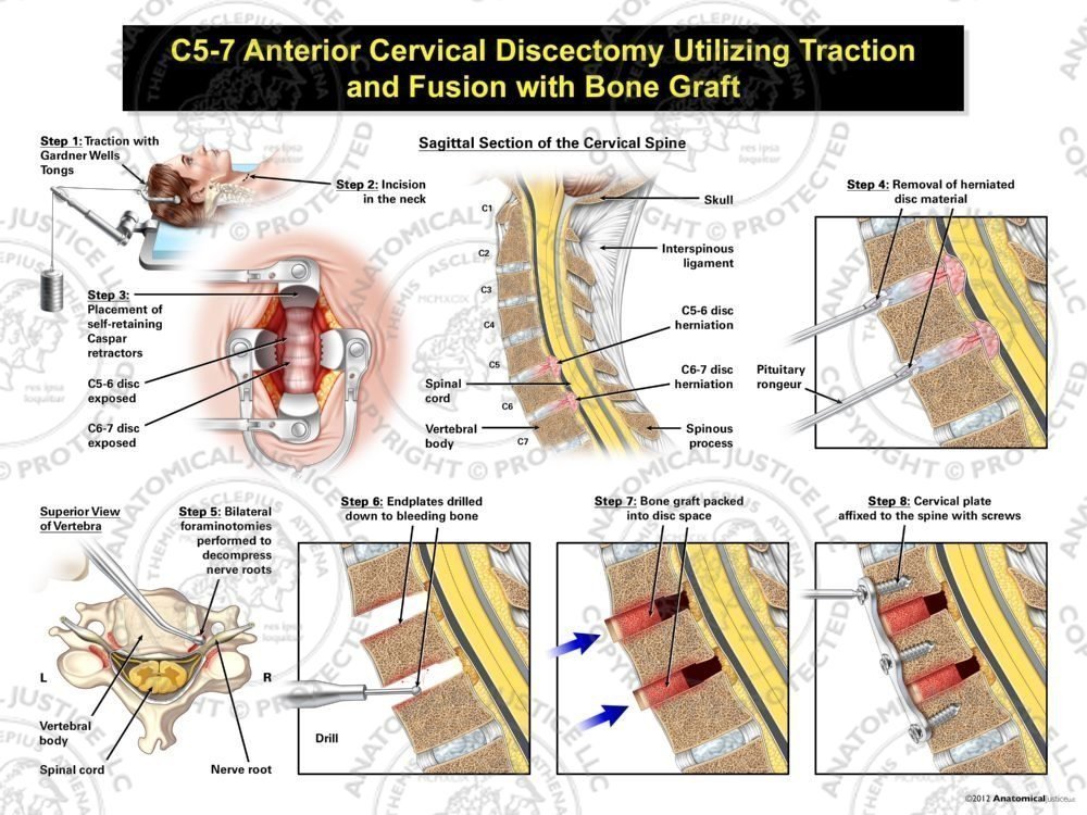Female C5-7 Anterior Cervical Discectomy Utilizing Traction and Fusion with Bone Graft