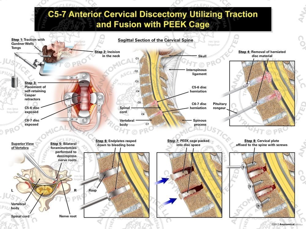 Male C5-7 Anterior Cervical Discectomy Utilizing Traction and Fusion with PEEK Cage