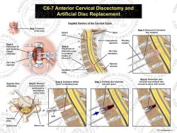 C6-7 Anterior Cervical Discectomy and Artificial Disc Placement
