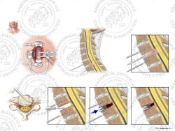 C6-7 Anterior Cervical Discectomy and Artificial Disc Placement – No Text