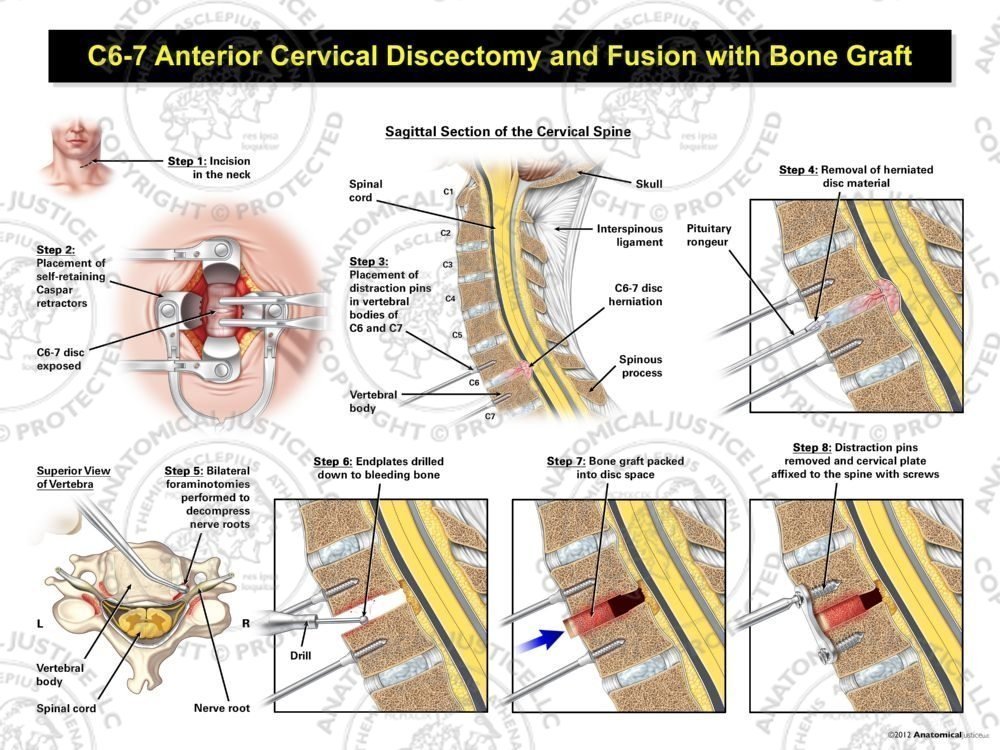 C6-7 Anterior Cervical Discectomy and Fusion with Bone Graft