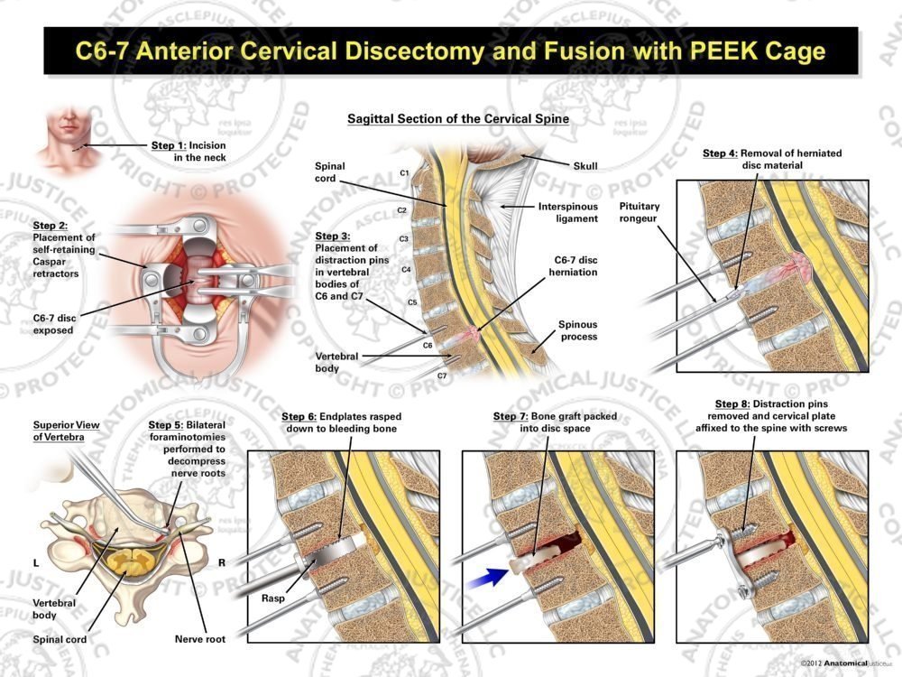 C6-7 Anterior Cervical Discectomy and Fusion with PEEK Cage
