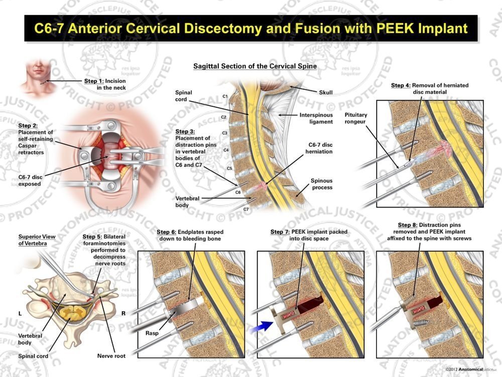 C6-7 Anterior Cervical Discectomy and Fusion with PEEK Implant