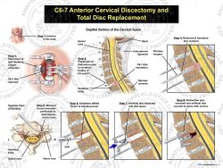 C6-7 Anterior Cervical Discectomy and Total Disc Replacement