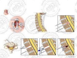 C6-7 Anterior Cervical Discectomy and Total Disc Replacement – No Text