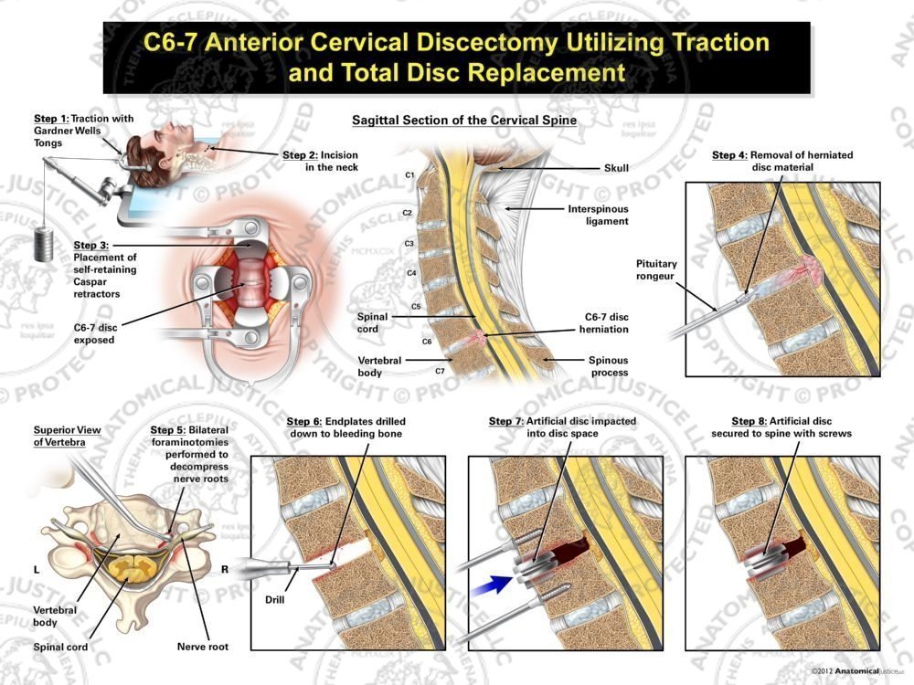 Male C6-7 Anterior Cervical Discectomy Utilizing Traction and Artificial Disc Placement