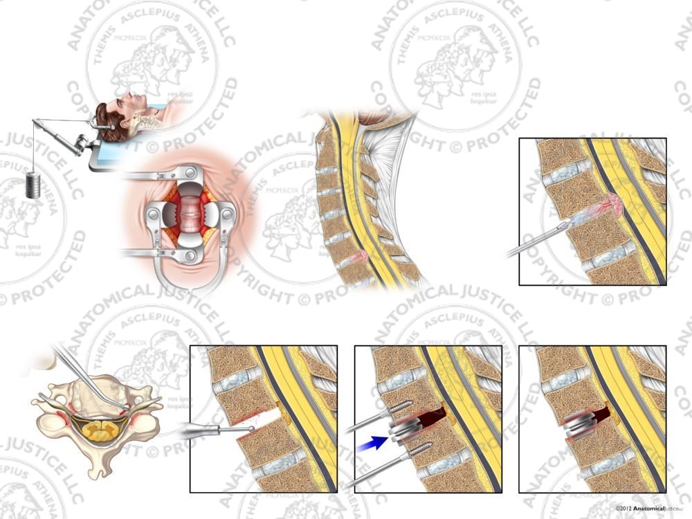 Male C6-7 Anterior Cervical Discectomy Utilizing Traction and Artificial Disc Placement – No Text