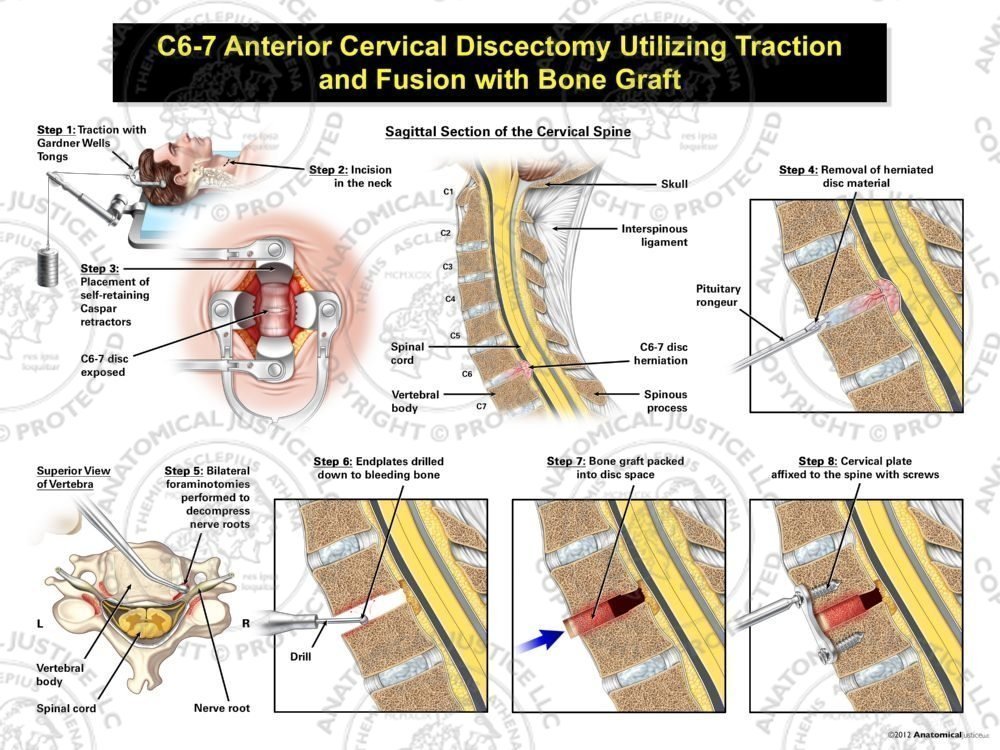 Male C6-7 Anterior Cervical Discectomy Utilizing Traction and Fusion with Bone Graft
