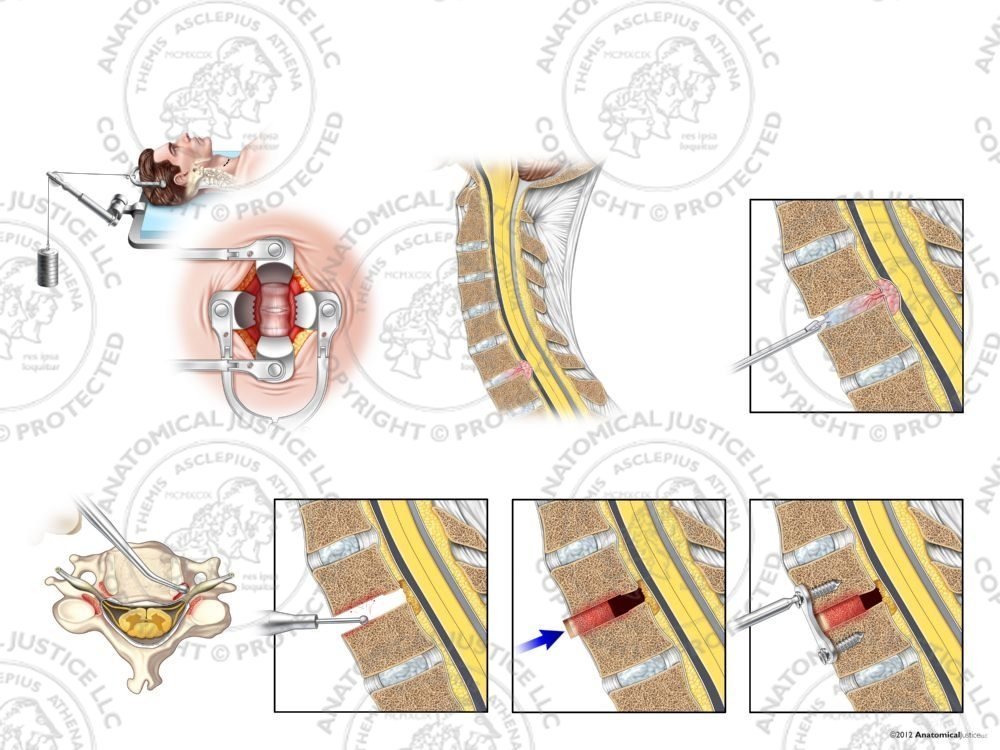 Male C6-7 Anterior Cervical Discectomy Utilizing Traction and Fusion with Bone Graft – No Text