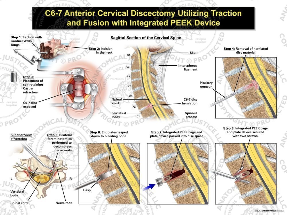 Male C6-7 Anterior Cervical Discectomy Utilizing Traction and Fusion with Integrated PEEK Device