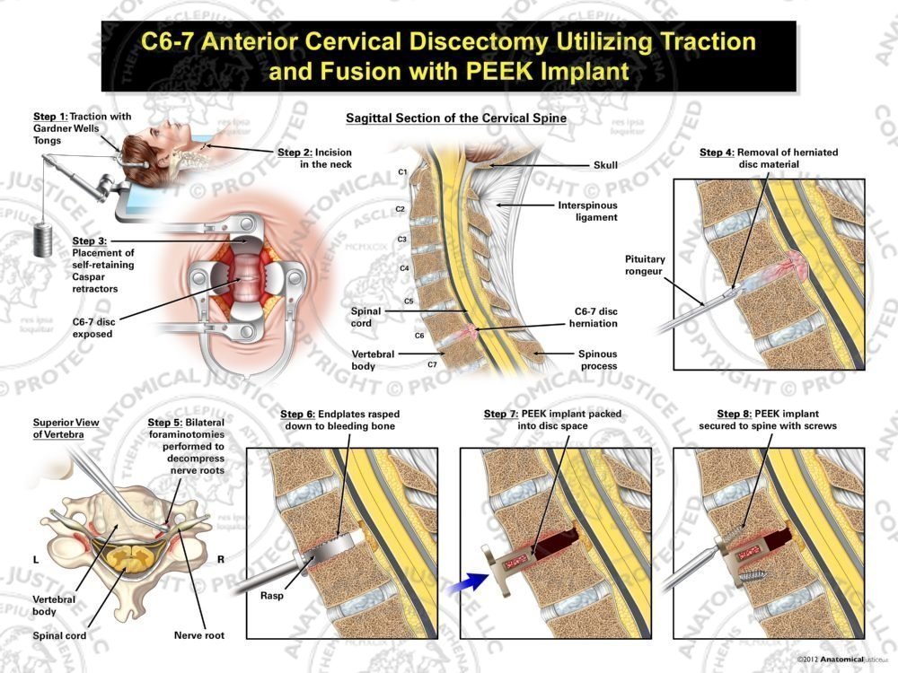 Female C6-7 Anterior Cervical Discectomy Utilizing Traction and Fusion with PEEK Implant