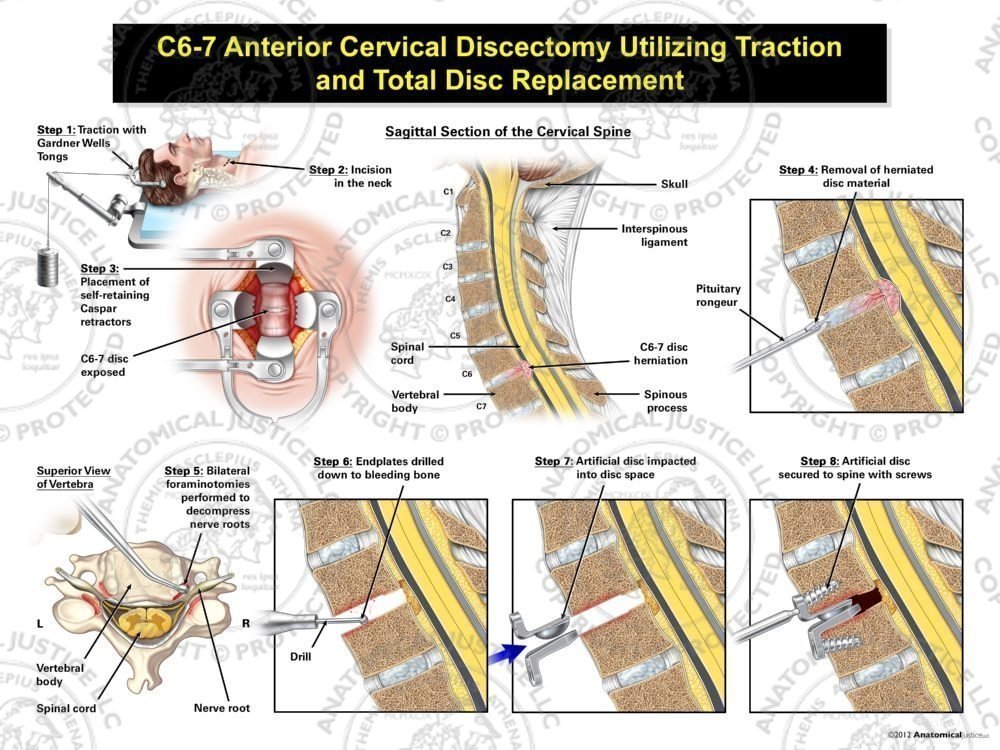 Male C6-7 Anterior Cervical Discectomy Utilizing Traction and Total Disc Replacement