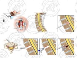 Female C6-7 Anterior Cervical Discectomy Utilizing Traction and Total Disc Replacement – No Text