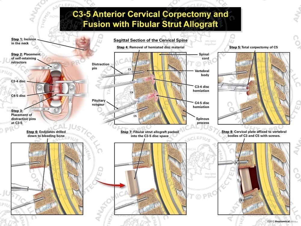C3-5 Anterior Cervical Corpectomy and Fusion with Fibular Strut Graft